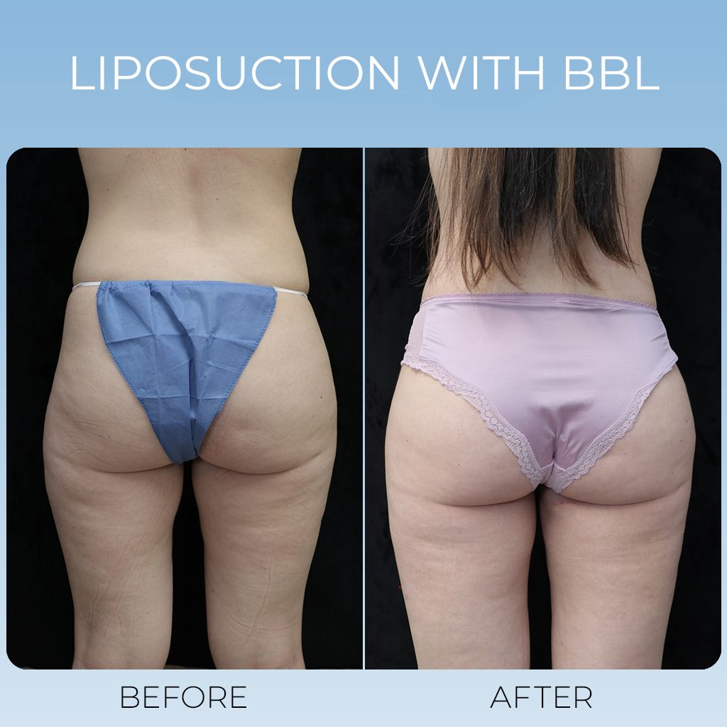 Liposuction with BBL (3)