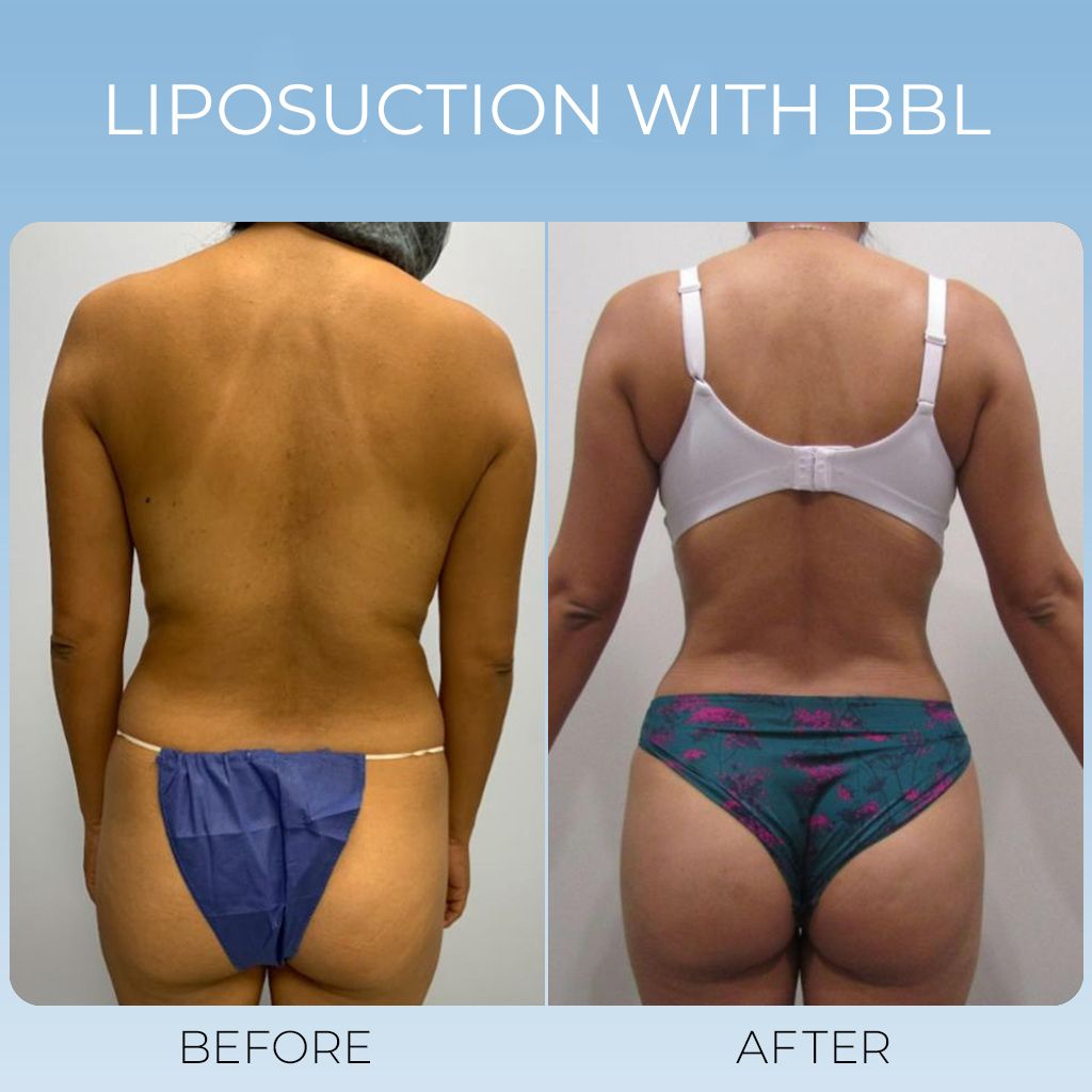 Liposuction with BBL (6)