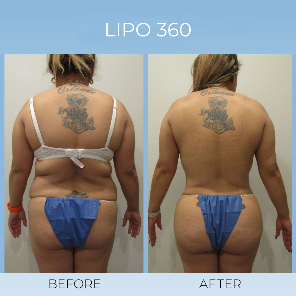 Liposuction with BBL